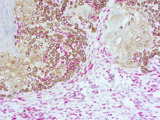 Immunohistochemical doublestaining of patient-derived lung cancer model